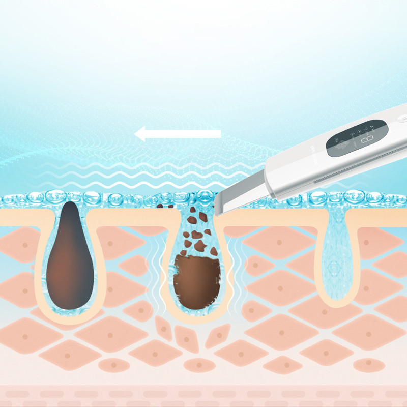 SONOFLY ultrahangos bőrradír EMS pulzusos mélytisztító akne mitesszer eltávolító arc peeling lifting szépségápolási eszközök A4