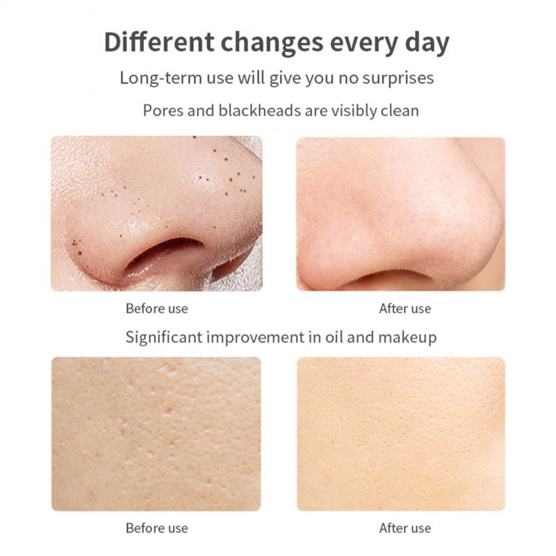 EMS Lopata Kožni nož Pozitivni negativni ioni Uvoz Izvoz Mast za mitesere Sredstvo za čišćenje pora Ultrazvučni stroj za lopatu