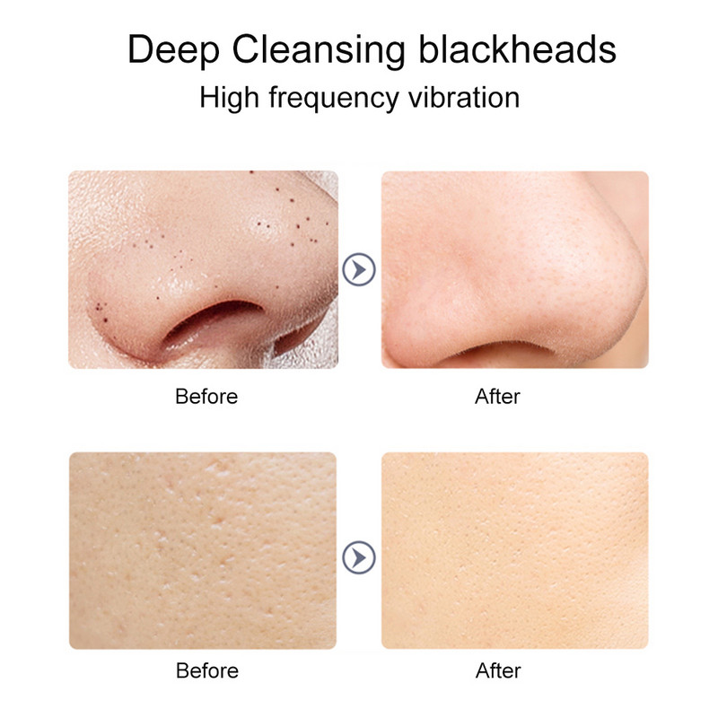 Professzionális ultrahangos arcbőrradír tisztító mitesszer peeling lapátos tisztító ion akne bőrápoló eszközök