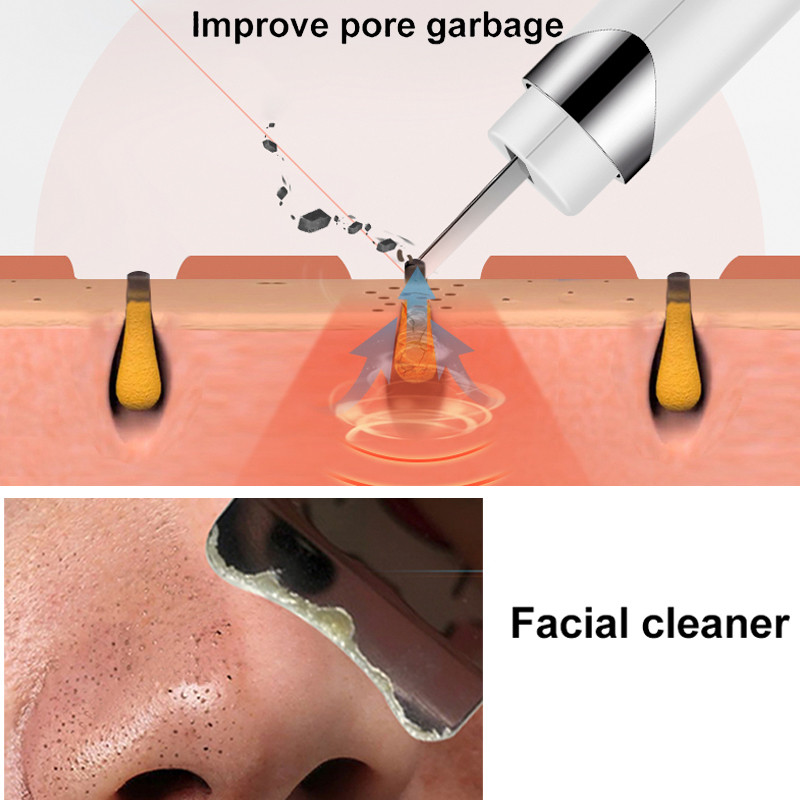 Youmay ultrahangos bőrradír mély arctisztító gép vibráló peeling lapát Mitesszer eltávolító arcradír emelő eszköz