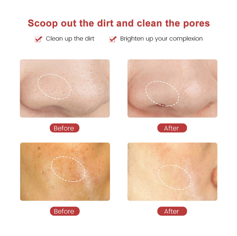 Ultrasonic Skin Scrubber Peeling Shovel Ion Acne Remover Face Lifting Facial Massager 5 Modes Deep Cleaning Machine