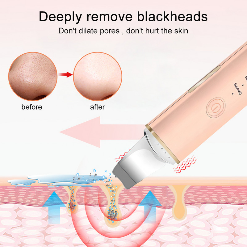 Ultrahangos arcbőrradír vibrációs orr spatula mitesszer eltávolító súroló lapát Tiszta kavitációs peeling arc lifting