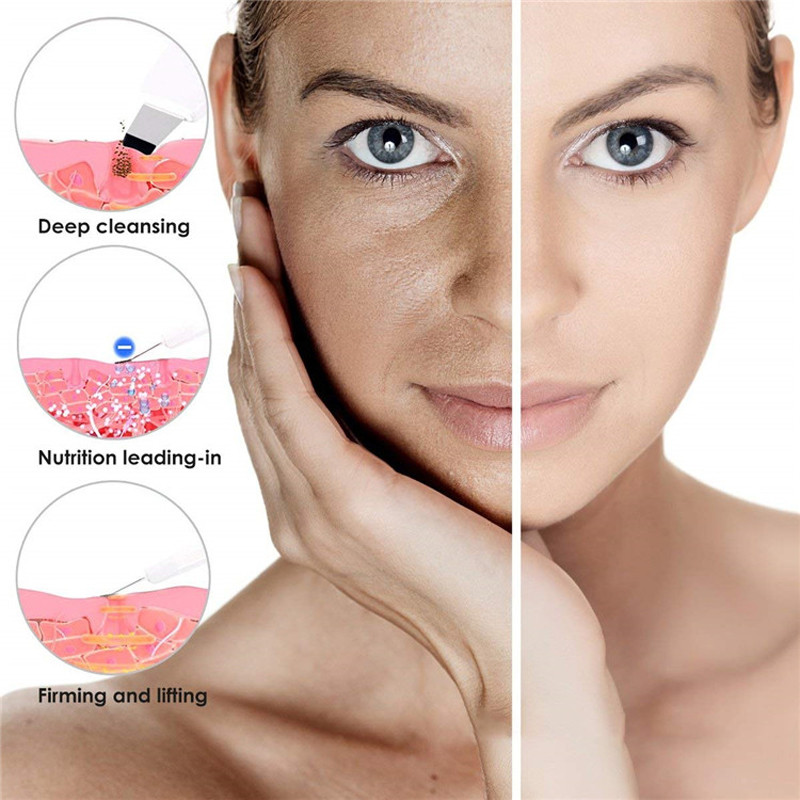 Ultrahangos arcbőrradír peeling lapát arcpórusok mélytisztító spatula mitesszer eltávolító újratölthető szépségápoló gép
