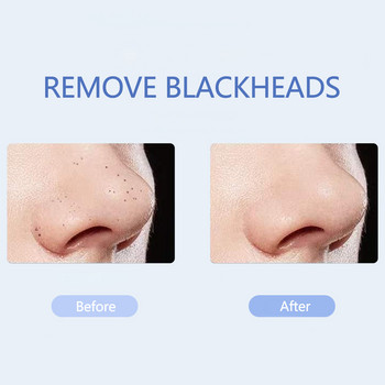 Ultrasonic Skin Scrubber Skin Peeling Machine Facial Cleansing Shatter Blackheads Import Nutrition Lifting