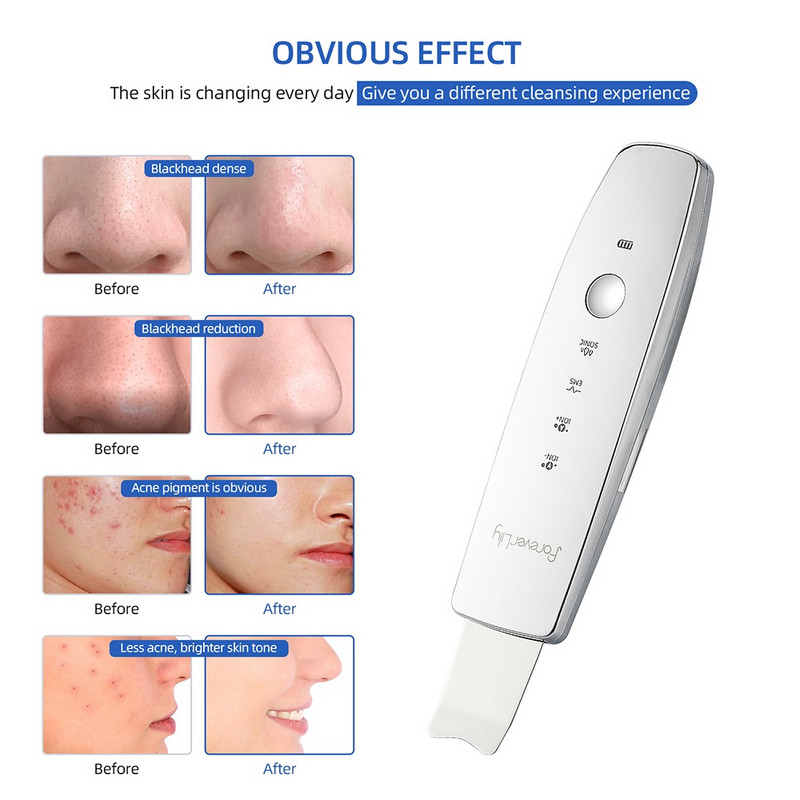 Ultrahangos bőrradír peeling lapát Ion akne mitesszer eltávolító mély arctisztító gép arc lifting arcmasszírozó