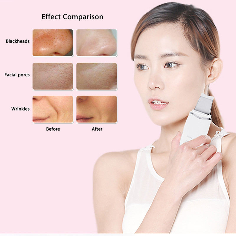 Ultrahangos bőrradír vibrációs arc spatula mitesszer eltávolító arcradír lapát Tiszta kavitációs peeling arc lifting