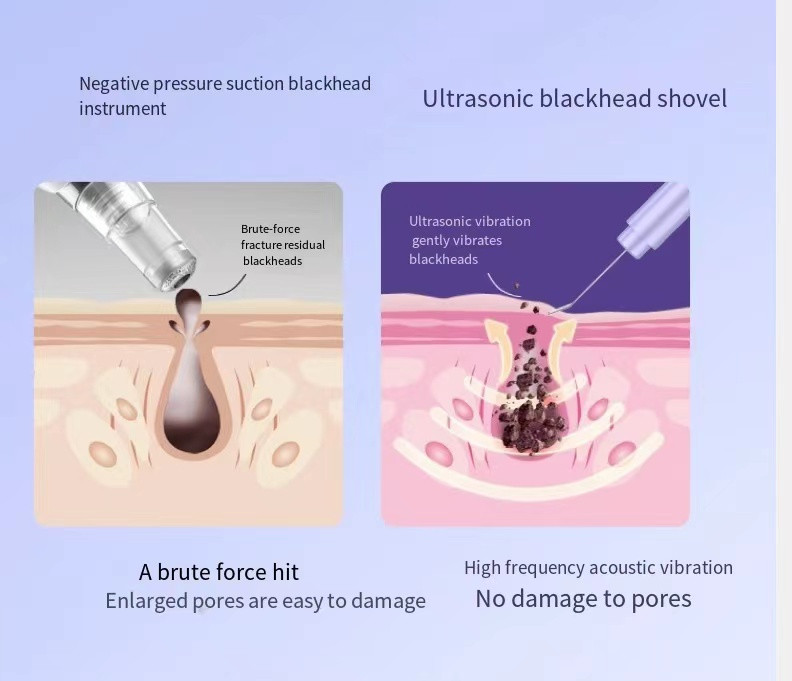 Ultrahangos bőrradír peeling lapát EMS mikroáramú ion akne mitesszer eltávolító arc mélytisztító arc lifting eszközök