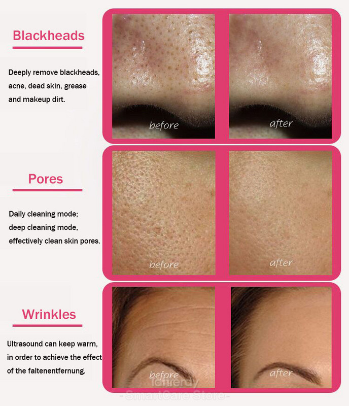 Ultrahangos arctisztító bőrradír pórustisztítás akne mitesszerek ránctalanítás rf beauty gép arc lifting vízhámlasztás