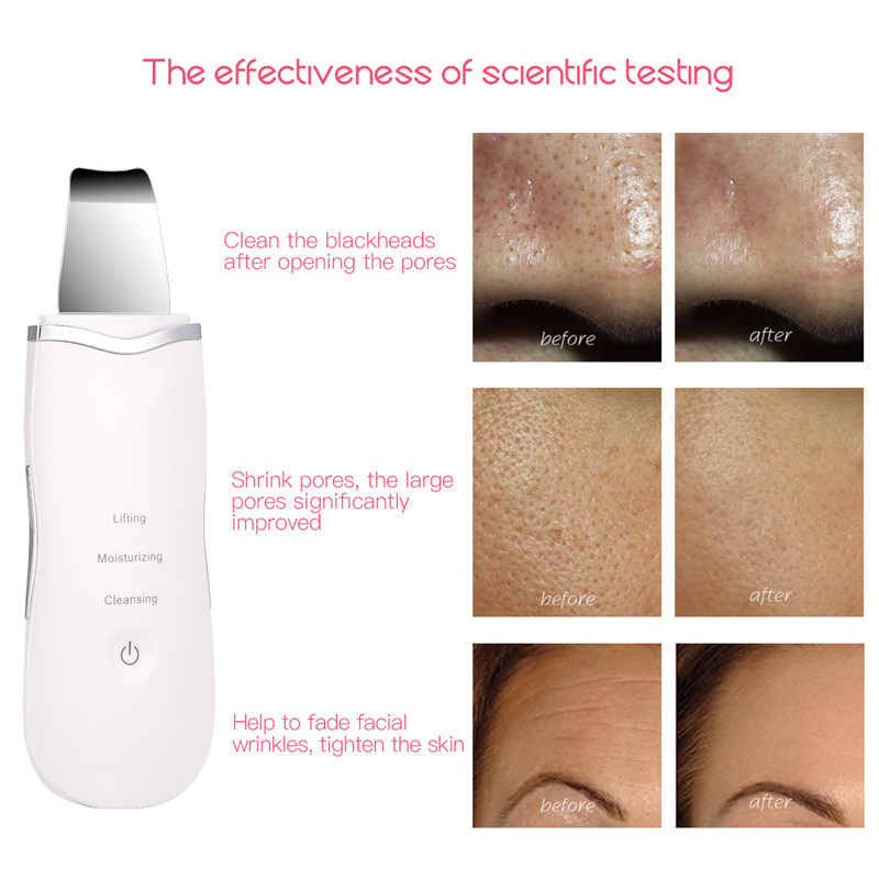 Újratölthető ultrahangos arcbőrradír arctisztító peeling vibrációs mitesszer eltávolító hámlasztó pórustisztító eszközök
