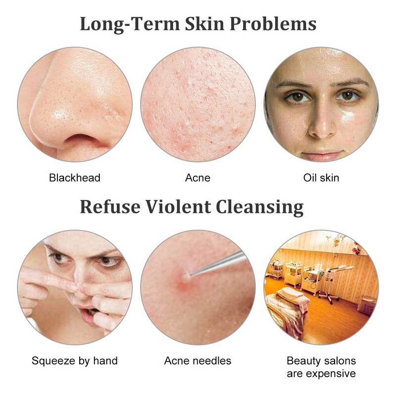Vibrációs arc spatula ultrahangos bőrradír mitesszer eltávolító arcradír lapát Tiszta kavitációs peeling arc lifting