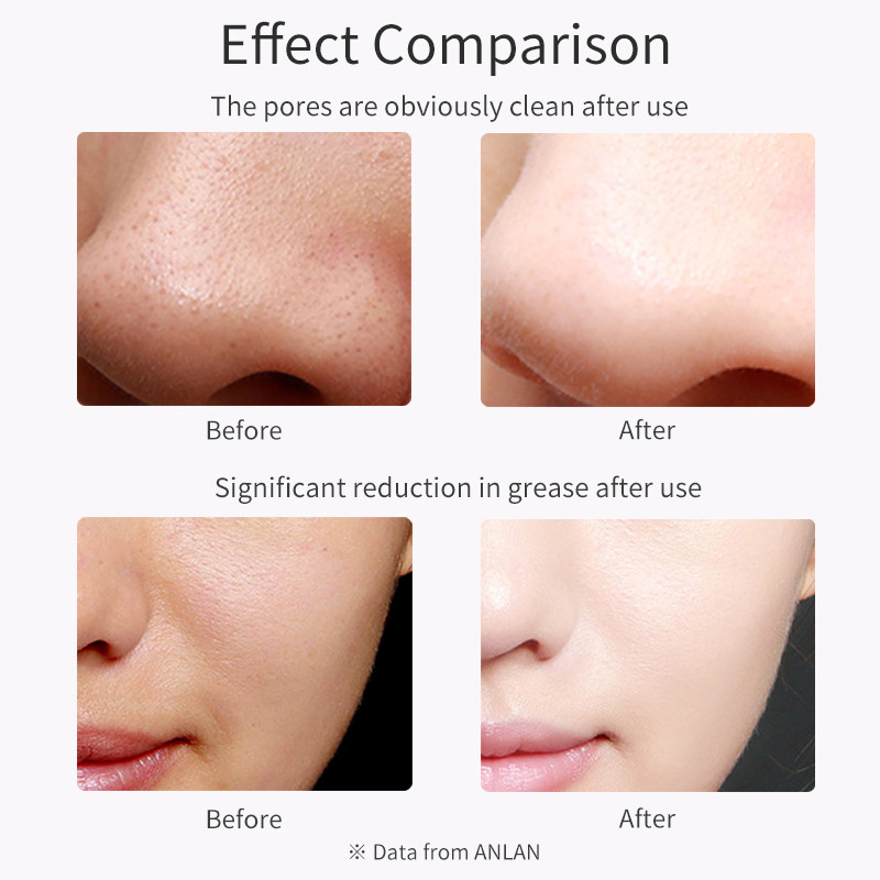 Ultrasonic Skin Scrubber Deep Face Cleaning Machine Peeling Shovel Facial Pore Cleaner Face Skin Scrubber Lift Machine