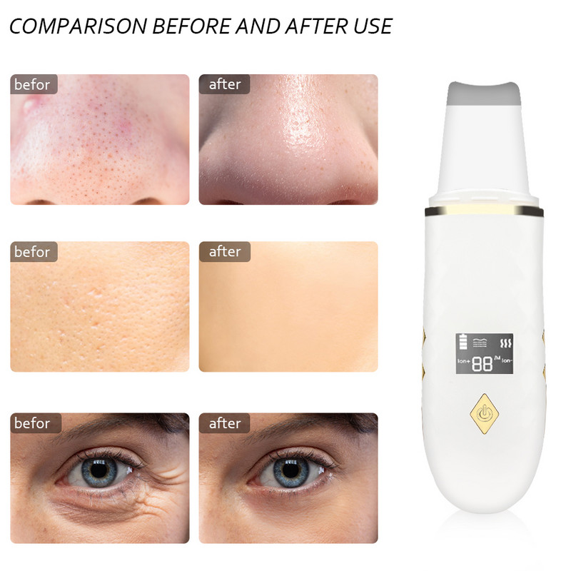 Ultrahangos bőrradír Arckezelés Ion Mély pórusok Tisztítás Akne mitesszer ránctalanítás Peeling Extractor Bőrfehérítés