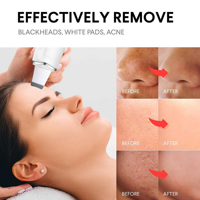 Beauty Ultrahangos bőrradír RF arcmasszírozóval Arc lifting Arcbőrápoló eszközök Pórustisztító Távolítsa el a mitesszer akne