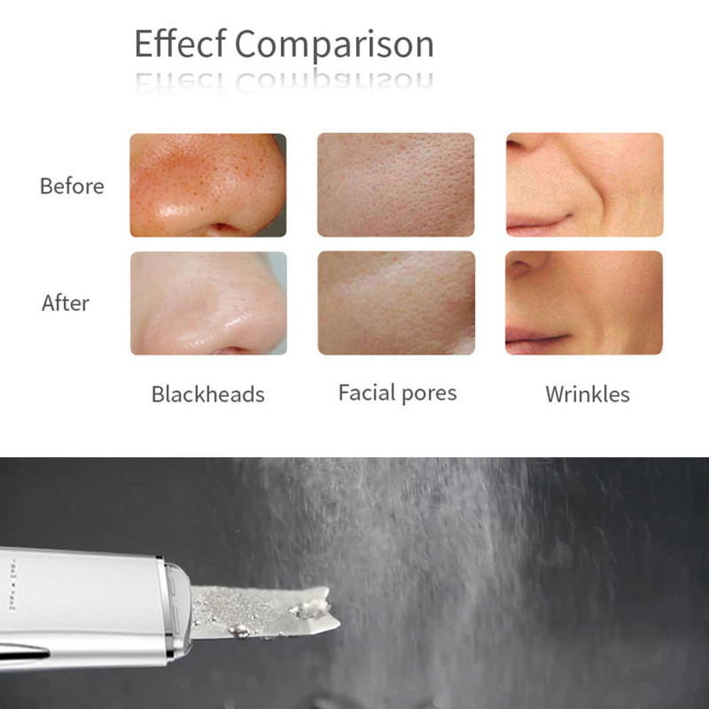 Ultrahangos bőrradír mély arctisztító gép peeling lapát arc pórustisztító arcbőrradír lifting gép