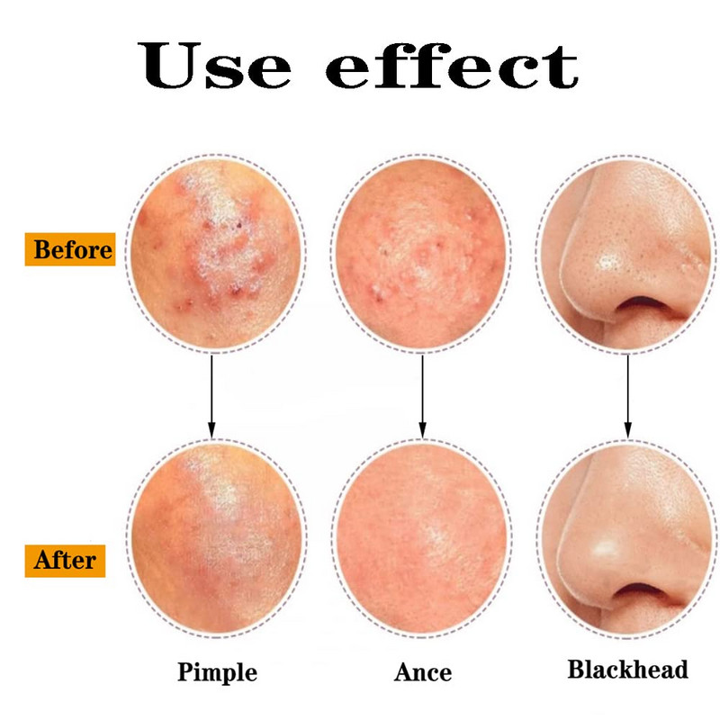 Njemački Ultra-fini No. 5 Cell Prištići na licu Miteseri Clip Pinceta Precizni Whitehead Akne Mrlje Komedoni Alat za šminkanje