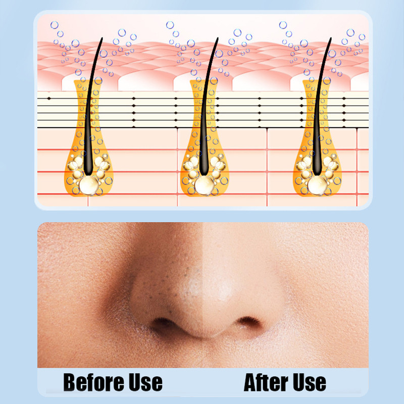 Εργαλεία καθαρισμού προσώπου με επαναφορτιζόμενο USB κύκλου νερού, ηλεκτρική σκούπα προσώπου, ηλεκτρικό σπυράκι αφαίρεσης μαύρου κεφαλιού