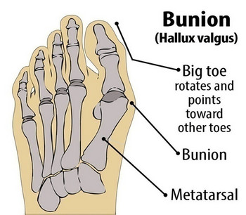 Διαχωριστικό δακτύλων Κάλτσες Ρυθμιστής αντίχειρων Ισιωτικό Πόδι Ορθωτική Συσκευή Νάρθηκα Hallux Valgus Διορθωτικό μανίκι