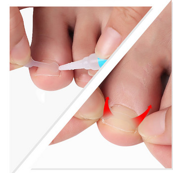 20-4 τμχ Θεραπεία νυχιών προς τα μέσα δάχτυλα Εργαλείο διόρθωσης νυχιών με ελαστικό έμπλαστρο Εργαλεία πεντικιούρ με κλιπ ισιώματος