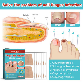 Лепенка за третиране на ноктите South Moon Антигъбични стикери за корекция на ноктите Грижа за врастнали нокти на краката Възстановяваща лепенка против паронихия против инфекции