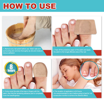 Лепенка за третиране на ноктите South Moon Антигъбични стикери за корекция на ноктите Грижа за врастнали нокти на краката Възстановяваща лепенка против паронихия против инфекции
