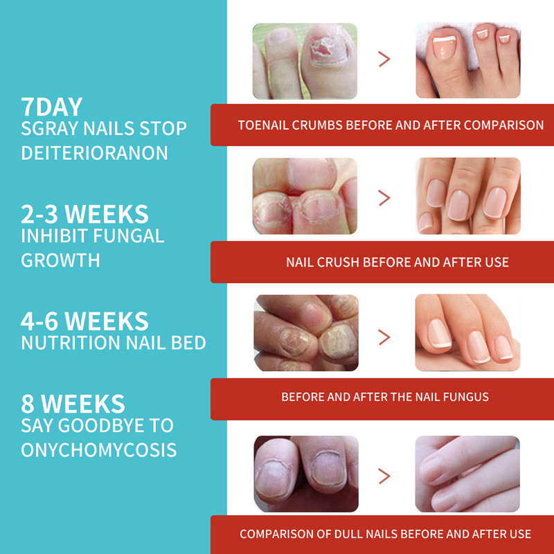 „South Moon“ nagų gydymo pleistras nuo grybelio koreguojantis nagus koreguojantis lipdukas įaugusių nagų priežiūrai paronichija nuo infekcijų atkuriantis pleistras