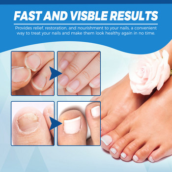 Лазерна писалка за лечение на нокти Безболезнена противогъбична инфекция Лазерно премахване на гъбички Грижа за онихомикоза Силен растеж Инструмент за възстановяване на ноктите на пръстите на краката