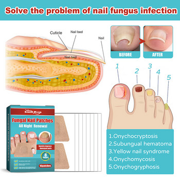 16PCS Коригиращ стикер за нощен ремонт Противогъбични удебеляващи пръсти на краката Гъбични лепенки за нокти Лечение на ноктите Здраве Грижа за ноктите