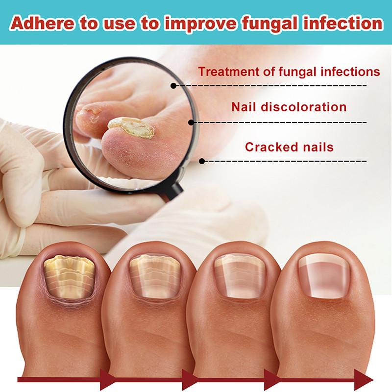 16 TK öine parandamine korrigeeriv kleebis seenevastane varvaste paksenemine seente seente küüneplaastrid Küünehooldus Tervislik küünehooldus