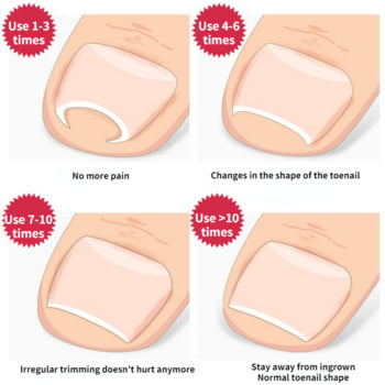 Κλιπ ισιώματος Ingrown Toenail Corrector Pedicure Εργαλεία περιποίησης νυχιών ποδιών από ανοξείδωτο ατσάλι Θεραπεία πεντικιούρ Onyxis Correction