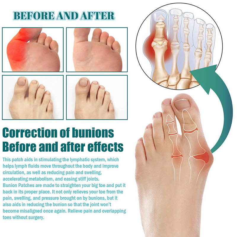 6 τεμάχια Bunion Paste Αυτοκόλλητα Αυτοκόλλητα Τακουνιού Αντιφθοράς Prevent Blister Food Pain Pain Pads