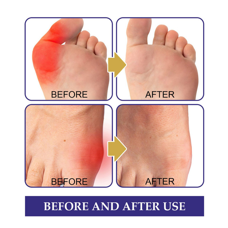 South Moon podagra raviplaaster Sõrme varba põlvevalu leevendav plaaster jalaliigese luu pöidlakorrektor Kleebised punnivastase plaastri