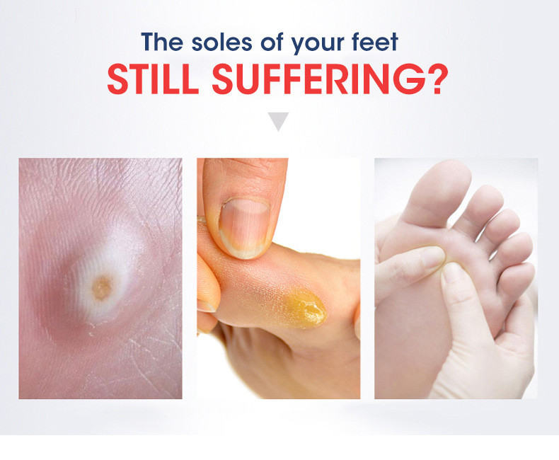 24. Εφαρμόστε πάστα ματιών κοτόπουλου για να αφαιρέσετε τους κάλους των κονδυλωμάτων πελματιαία πόδια ανακουφίζουν από τον πόνο και την κούραση