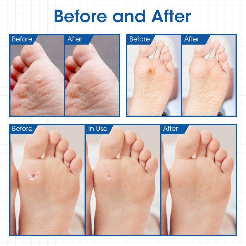 24. Εφαρμόστε πάστα ματιών κοτόπουλου για να αφαιρέσετε τους κάλους των κονδυλωμάτων πελματιαία πόδια ανακουφίζουν από τον πόνο και την κούραση