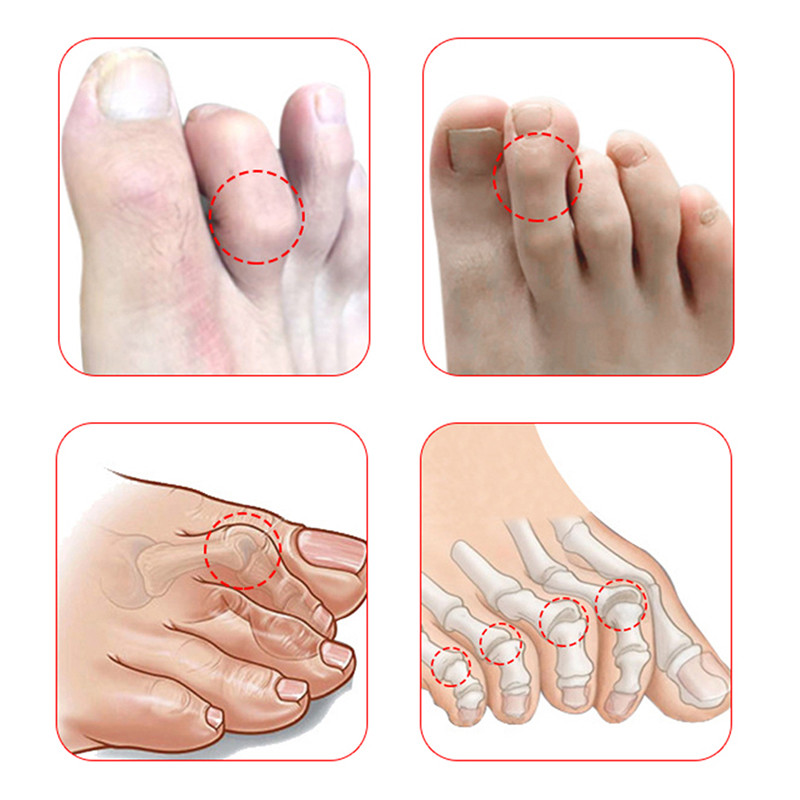 Sõrmetugi traks päästik Sõrme lahas dislokatsiooni tugi pöidla painutamise abil vööriliigese immobiliseerimine luumurru valu leevendamine