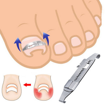 Инструмент за корекция на врастнали нокти Коректори за изправяне на ноктите на краката Инструмент за лепенки Щипка за изправяне Инструмент за педикюр