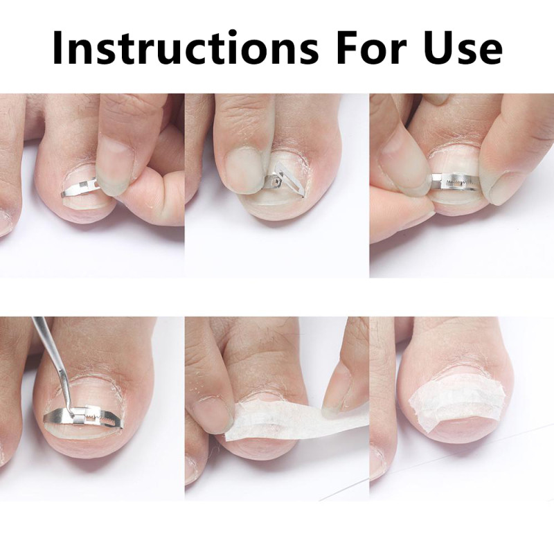 Alat za ispravljanje uraslog nokta Korektori za ispravljanje noktiju Alat za flaster Stezaljka za ravnanje Steznica Alat za pedikuru