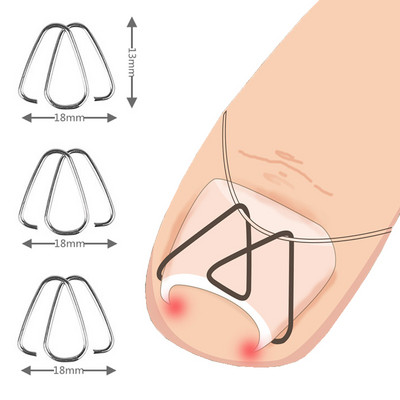 3 paari eesmine küünte konks/kummipael Nail Art sissekasvanud varba küünte korrigeerimine varbaküüne sissekasvanud küünte klamber Ortoos paronüühia pediküür