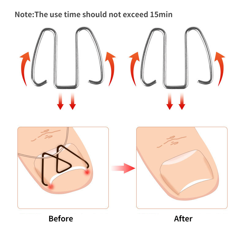 3 paari eesmine küünte konks/kummipael Nail Art sissekasvanud varba küünte korrigeerimine varbaküüne sissekasvanud küünte klamber Ortoos paronüühia pediküür