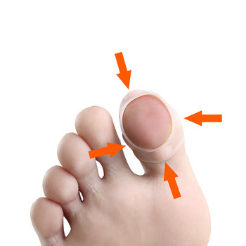 3 чифта Корекция на ноктите на краката Armor Corrector Tool Силиконова грижа за ноктите на краката Катарами Щипка